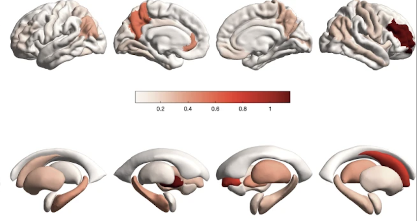 Preclinical Alzheimer's disease progression prediction