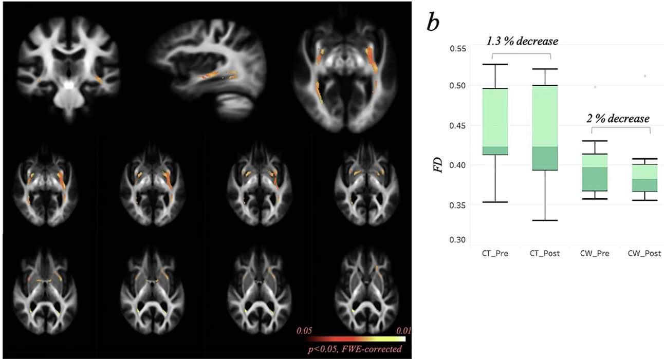 Multimodal cognitive training in mild cognitive impairment